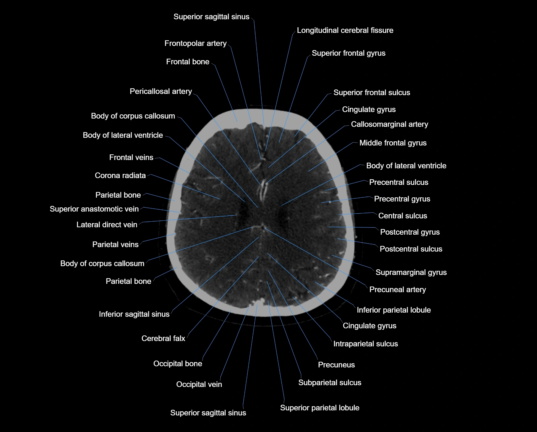 CT scan brain axial labelled cross sectional anatomy image-img-000049.webp